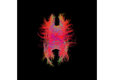 Particle Filtering Tractography